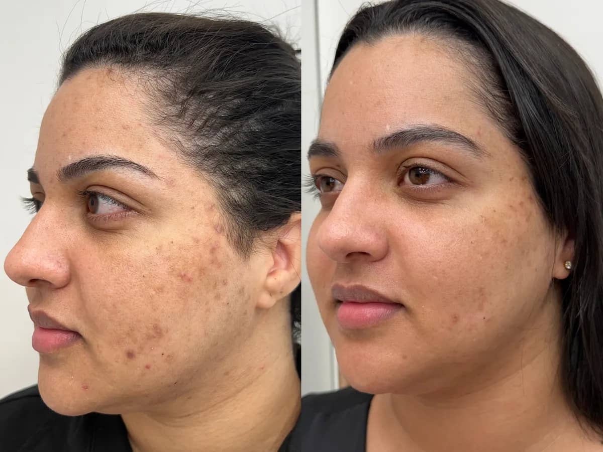 Comparação de dois momentos do rosto de uma mulher com acne inflamada nas bochechas