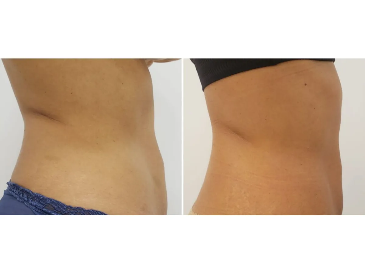 Comparação de dois momentos do braço de uma mulher, antes e depois de protocolo para inchaço