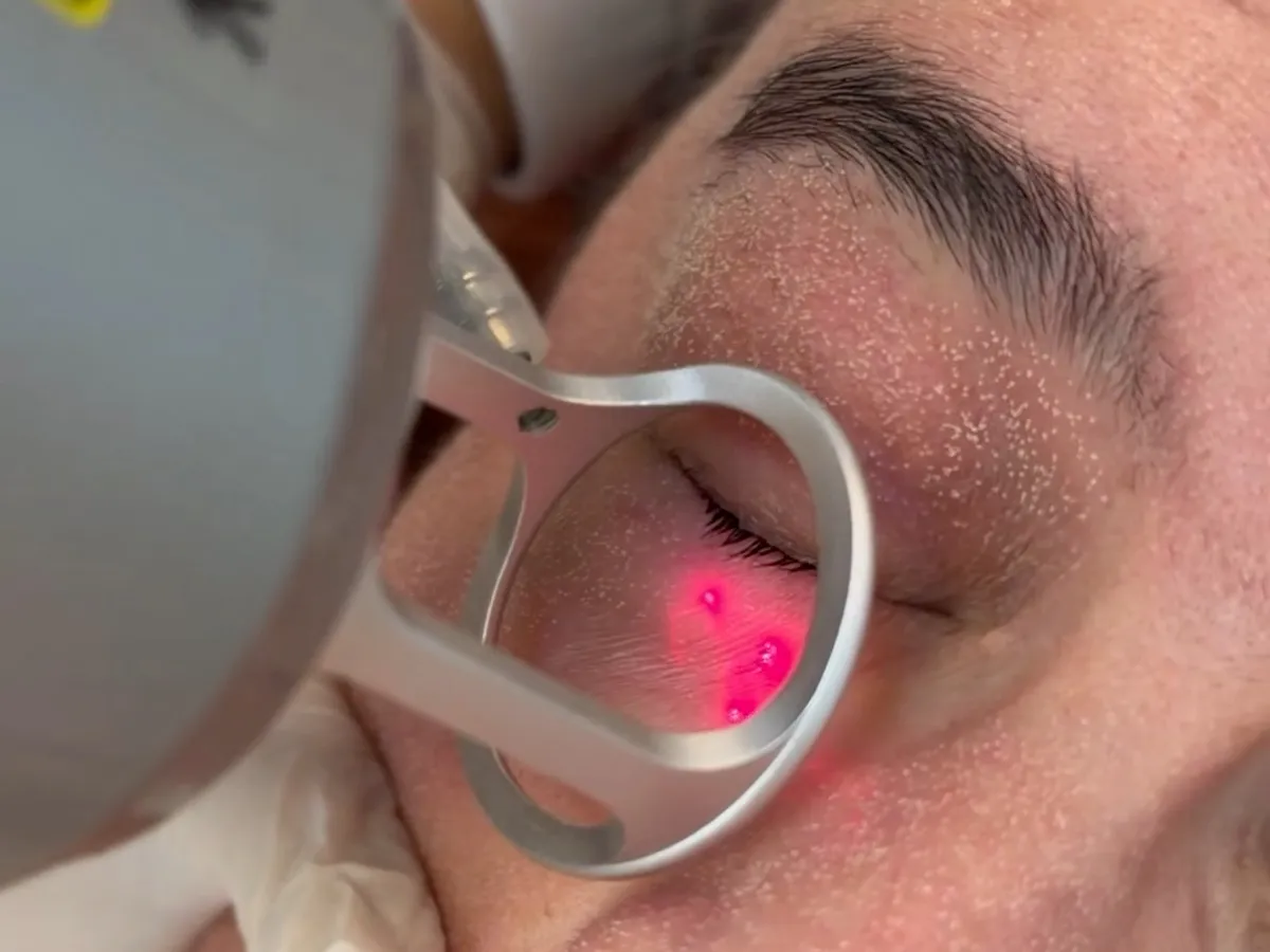 Laser CO₂ fracionado em uso no rosto de uma cliente, com óculos de proteção