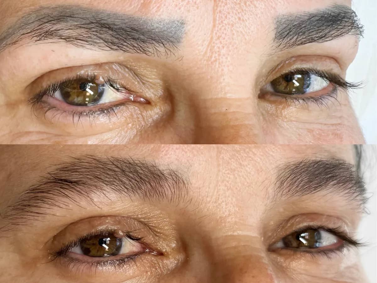 Comparação de dois momentos das sobrancelhas, antes e depois de sessões de remoção de micropigmentação a laser