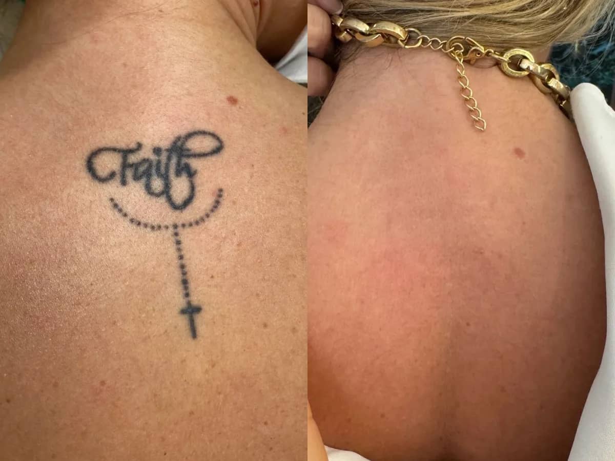 Antes e depois de remoção de tatuagem a laser atrás da orelha