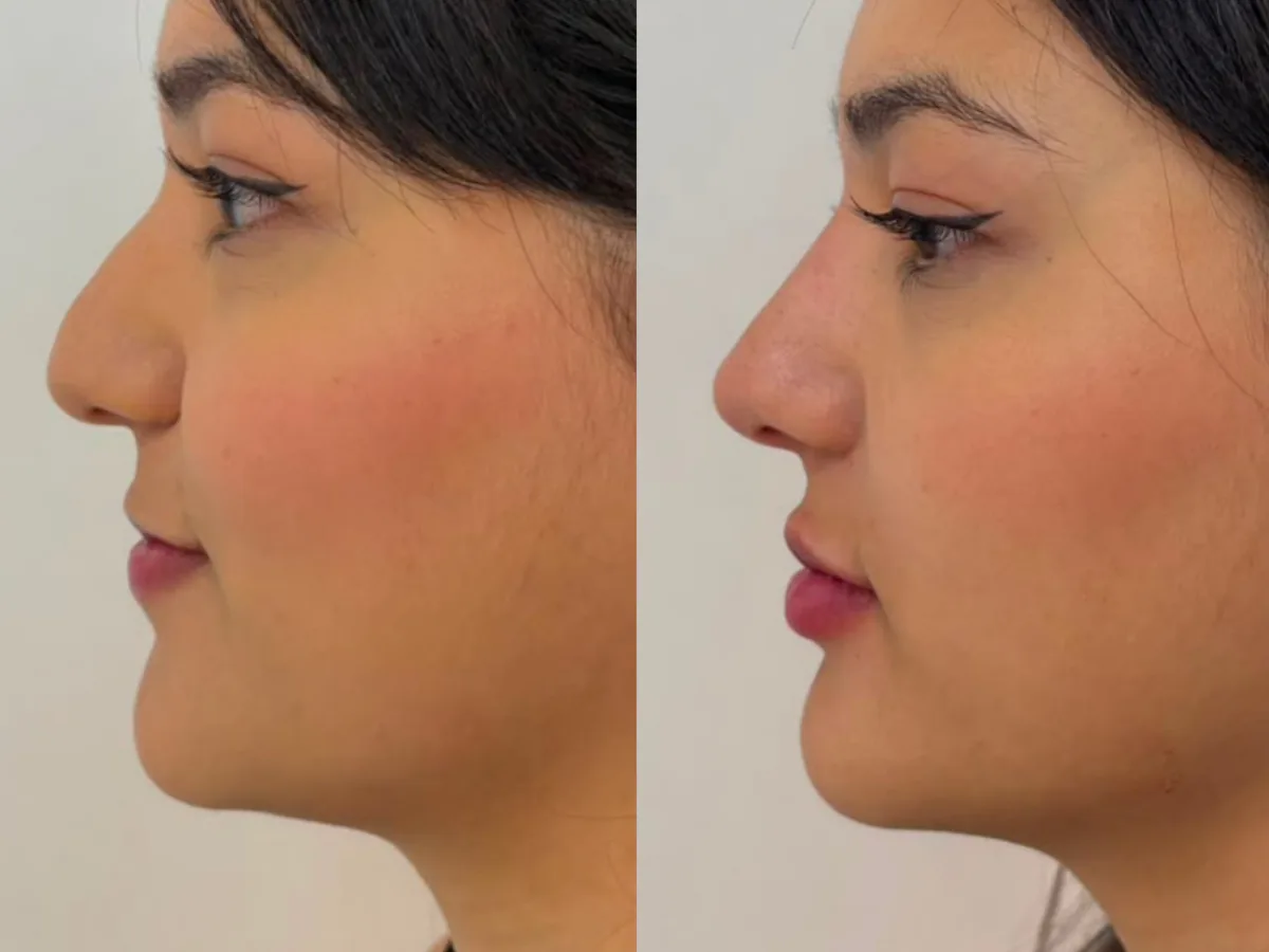 Comparação de dois momentos do perfil do rosto de uma mulher, antes e depois de rinomodelação