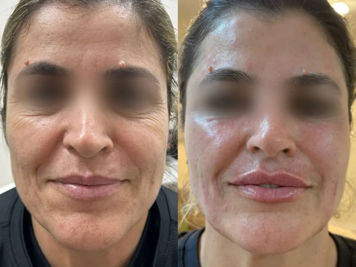 Comparação de dois momentos do rosto de uma mulher, com os olhos preservados, antes e depois de cuidado facial