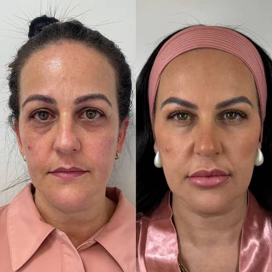 Antes e depois de tratamento facial na Q!Clinic, rosto de frente