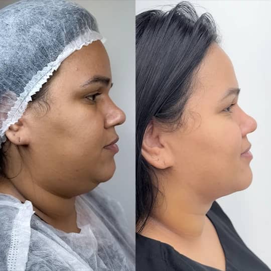 Antes e depois de tratamento da região da papada, perfil