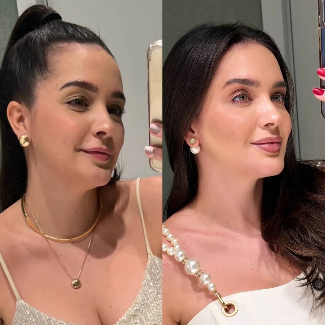 Antes e depois de harmonização facial, rosto de frente