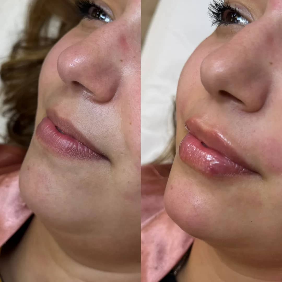 Antes e depois de preenchimento labial