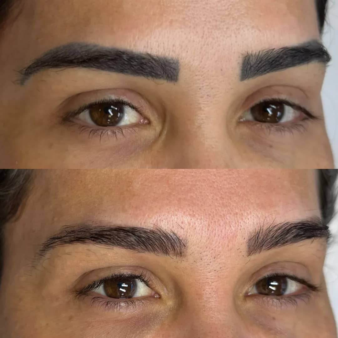 Antes e depois de remoção de micropigmentação de sobrancelhas a laser