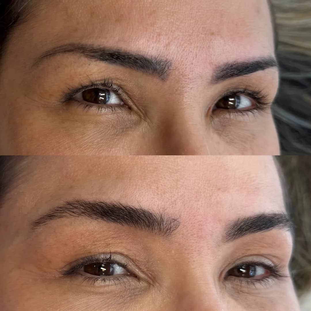 Antes e depois de remoção de micropigmentação de sobrancelhas a laser, segundo caso