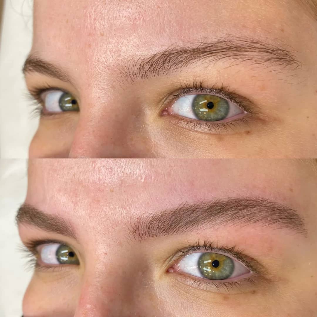 Antes e depois de remoção de micropigmentação de sobrancelhas a laser, terceiro caso