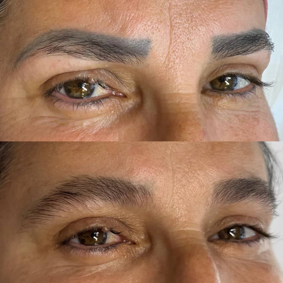 Antes e depois de remoção de micropigmentação de sobrancelhas a laser, quarto caso
