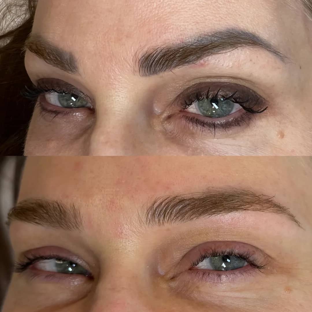 Antes e depois de remoção de micropigmentação de sobrancelhas a laser, quinto caso