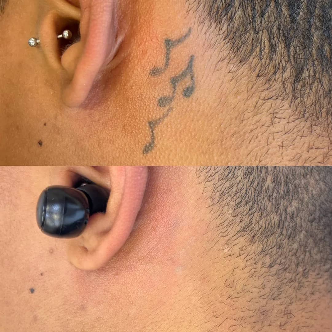 Antes e depois de remoção de tatuagem a laser atrás da orelha