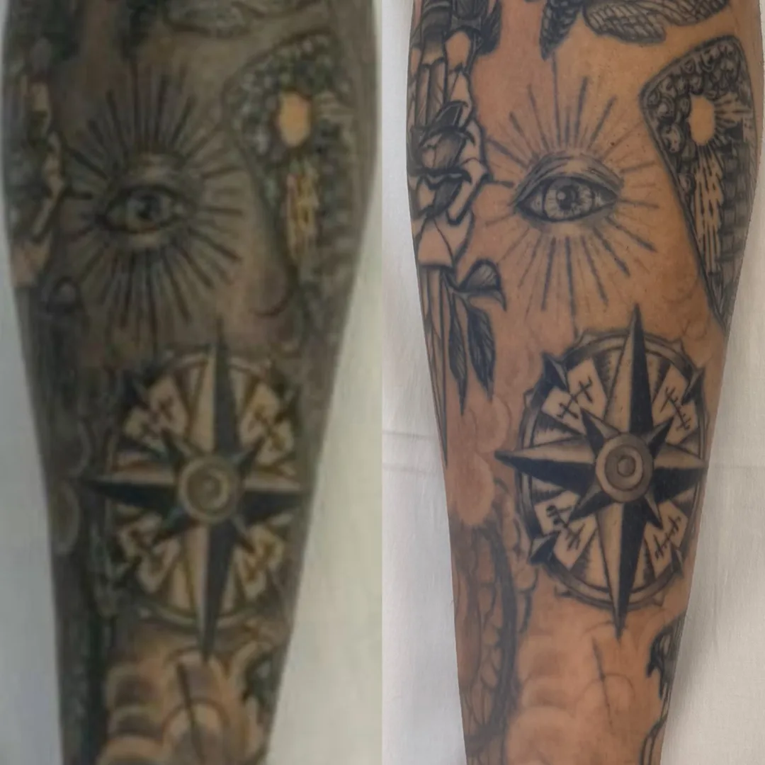 Antes e depois de remoção de tatuagem a laser em braço fechado, dois momentos do protocolo