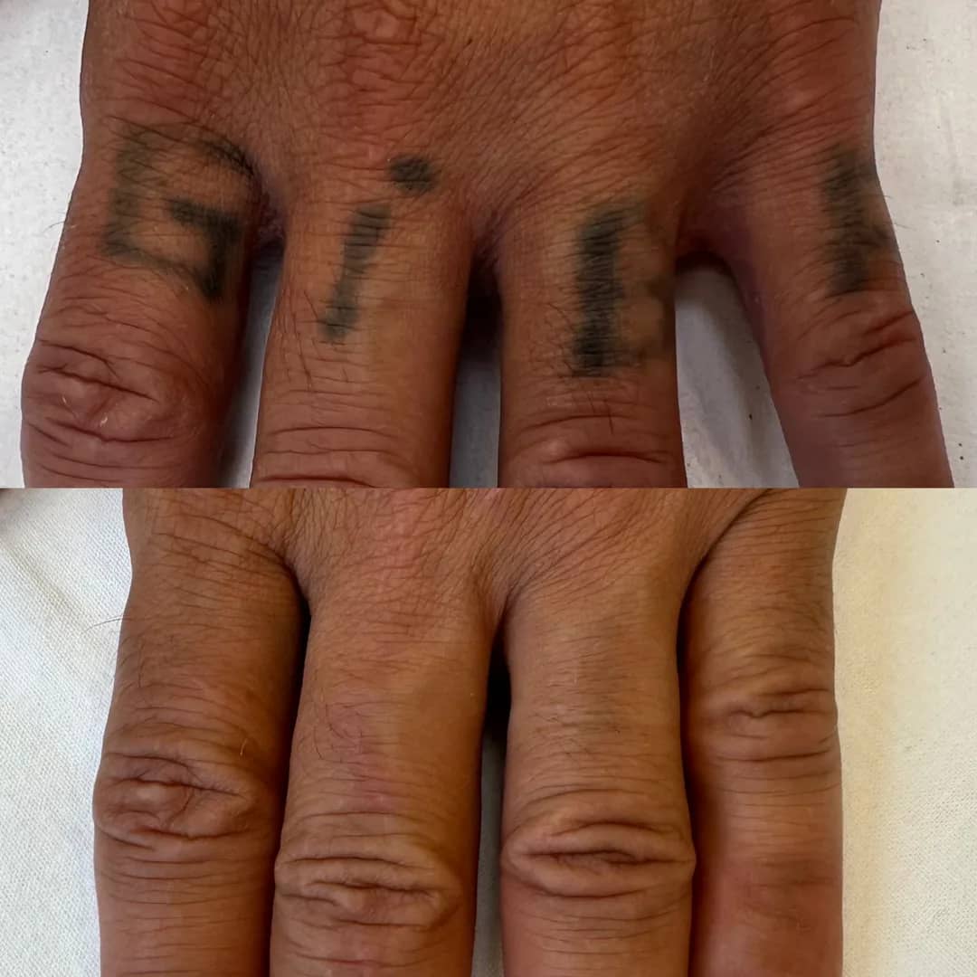 Antes e depois de remoção de tatuagem a laser nos dedos