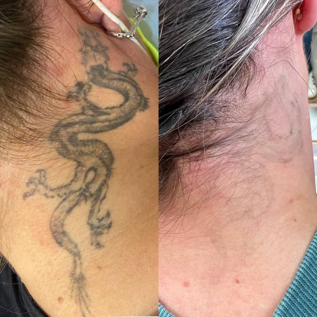 Antes e depois de remoção de tatuagem a laser na lateral do pescoço