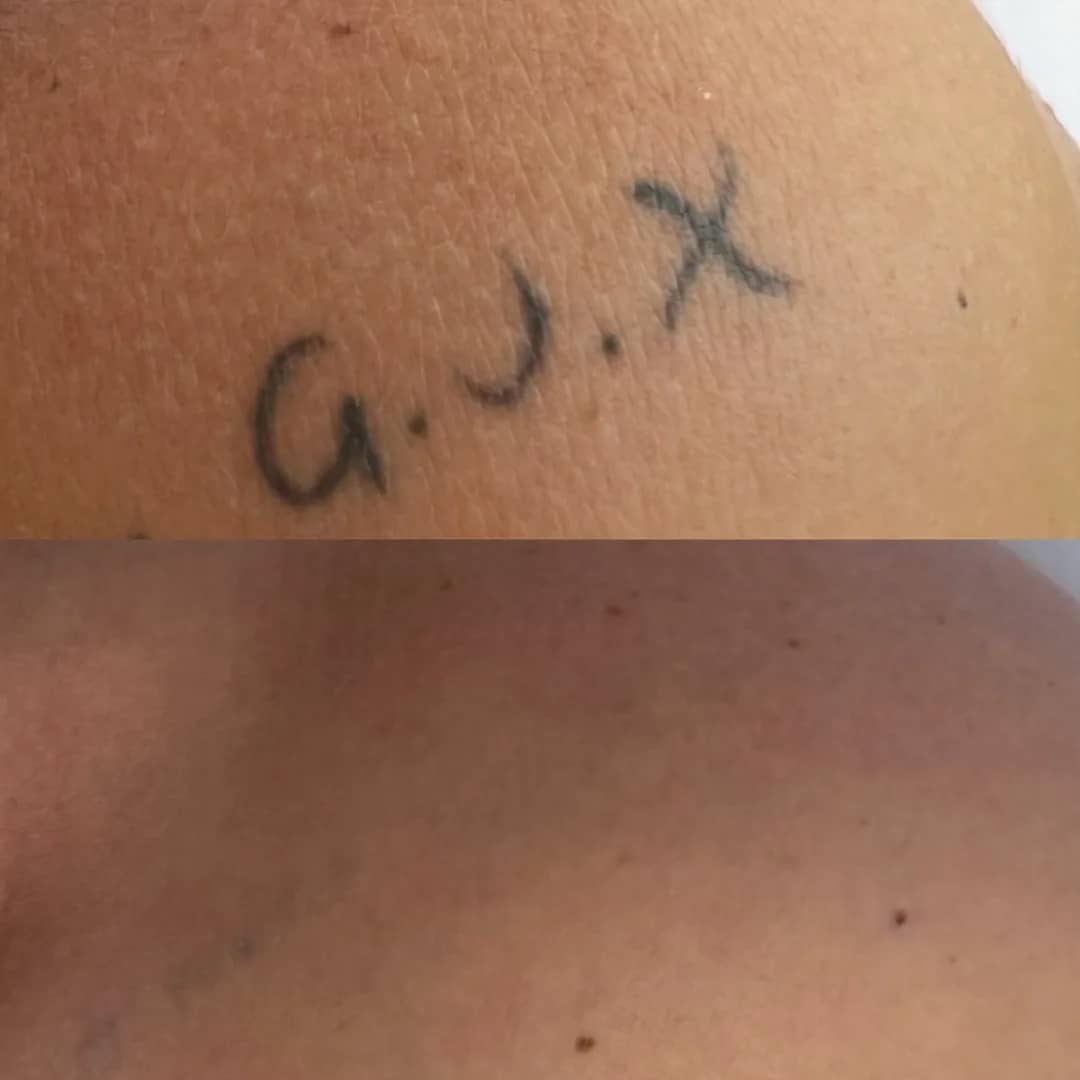 Antes e depois de remoção de tatuagem a laser de iniciais