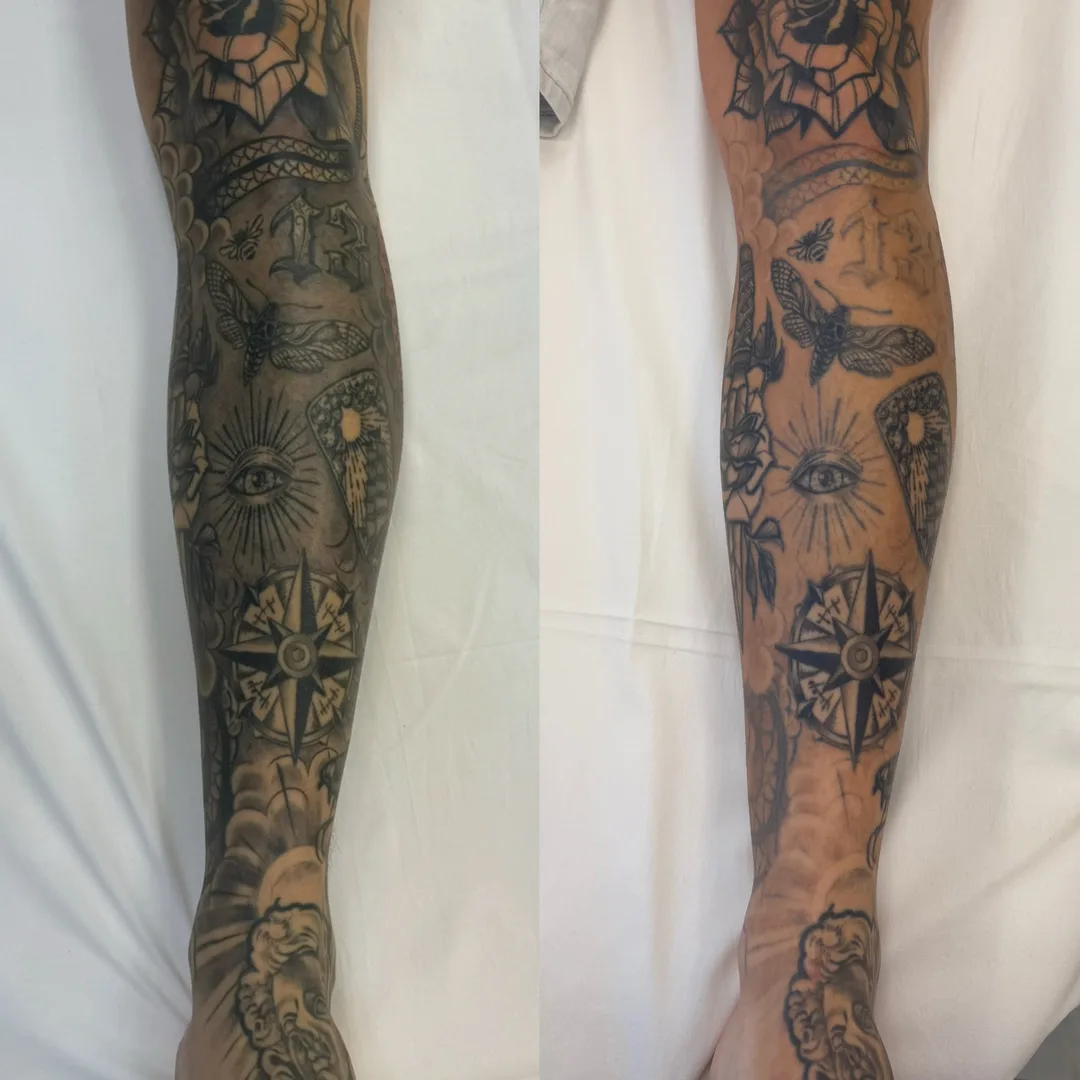 Antes e depois de remoção de tatuagem a laser nas pernas