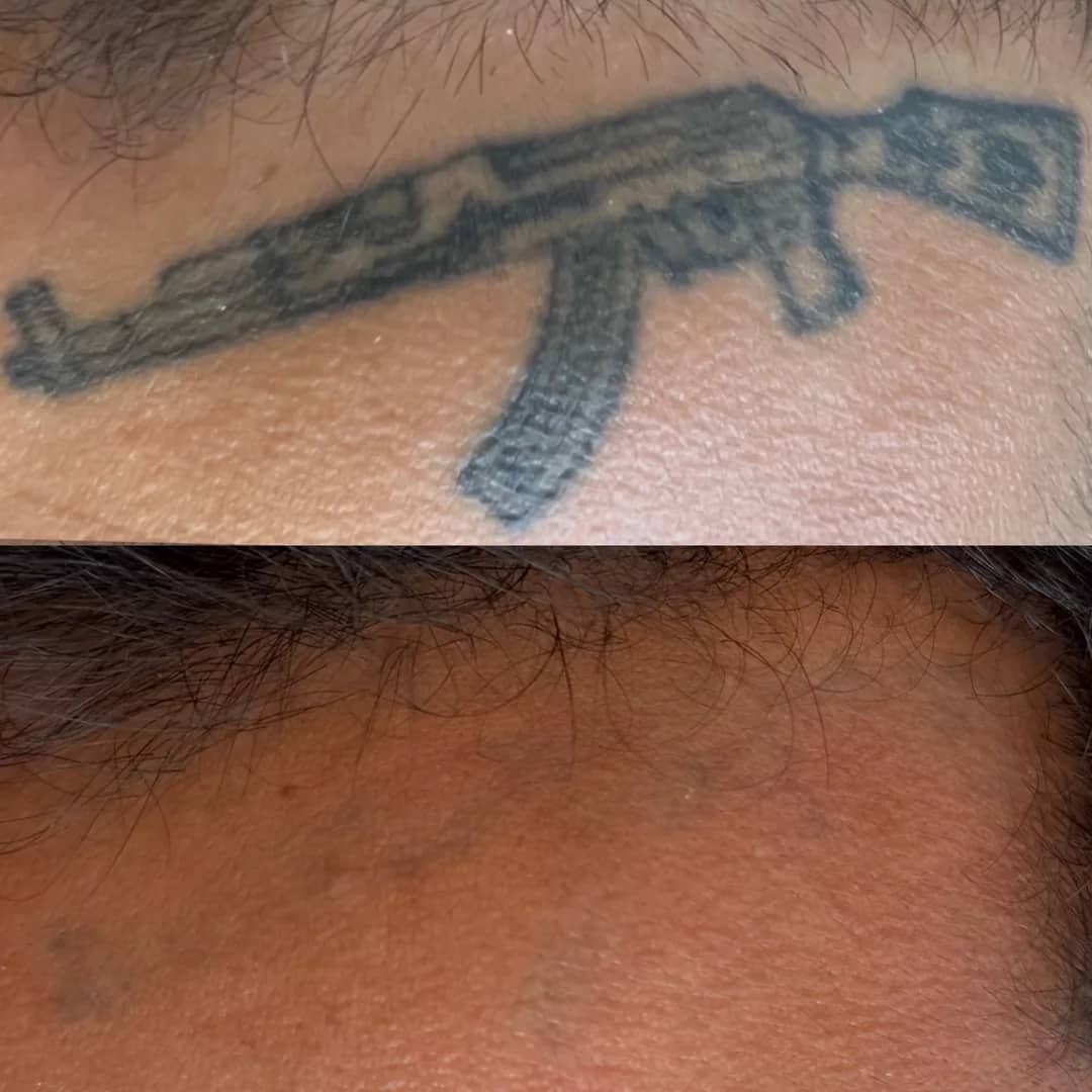 Antes e depois de remoção de tatuagem a laser no pescoço
