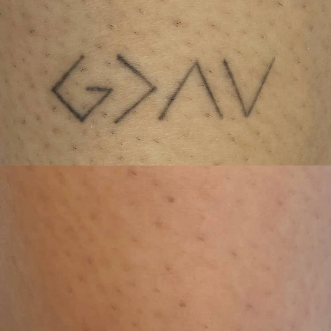 Antes e depois de remoção de tatuagem a laser com símbolos no braço
