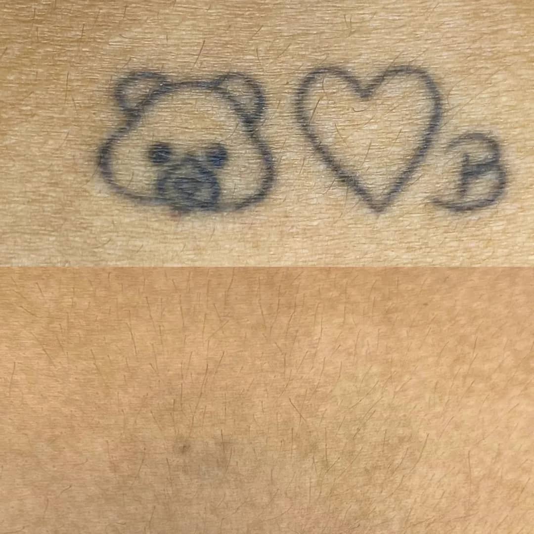 Antes e depois de remoção de tatuagem a laser de desenho pequeno com coração